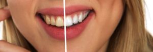 Bleaching - weiße Zähne - Zahnarzt Nidderau Ostheim